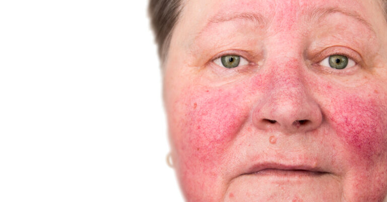 A closeup image of a woman's face shows her rosy, flushed cheeks.
